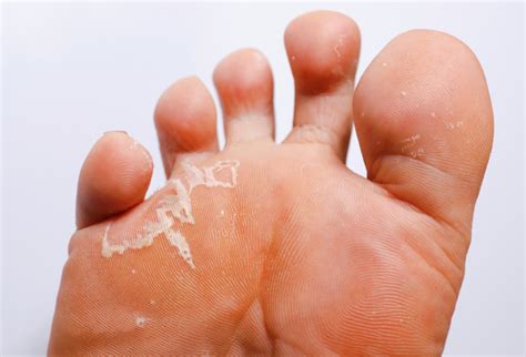 foot problems with pictures|athlete's foot on toes pictures.